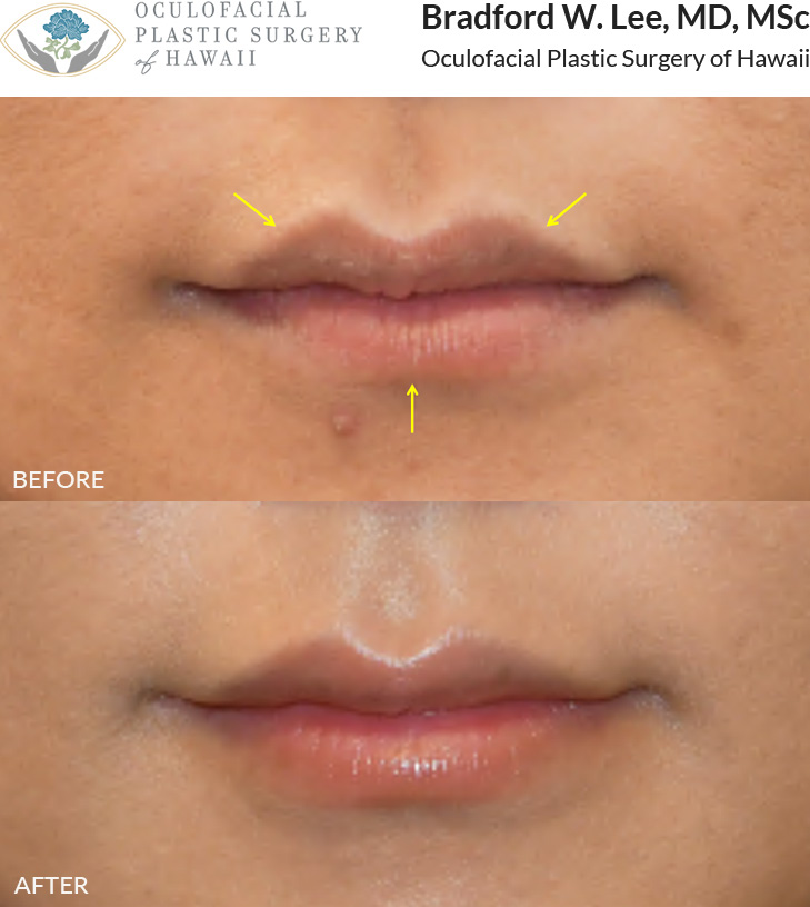 This patient wanted a more refined look with enhanced lip volume and chose dermal filler for a subtle, natural result.