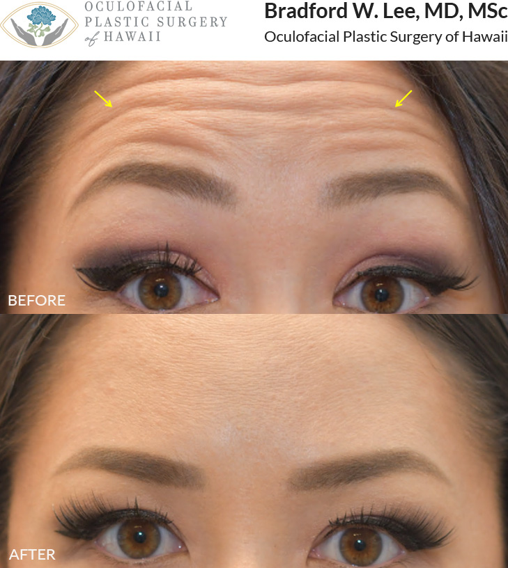 This patient was looking to soften the appearance of her dynamic forehead wrinkles.