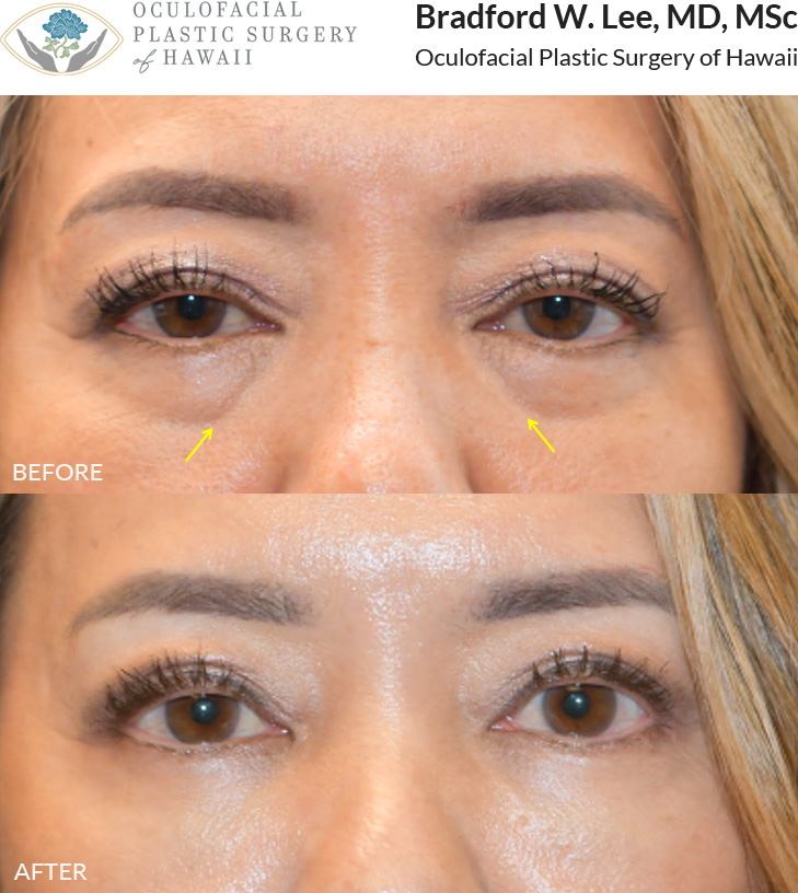 This patient was concerned about the hollowing under her eyes and chose tear trough filler to achieve a smoother, more refreshed appearance.