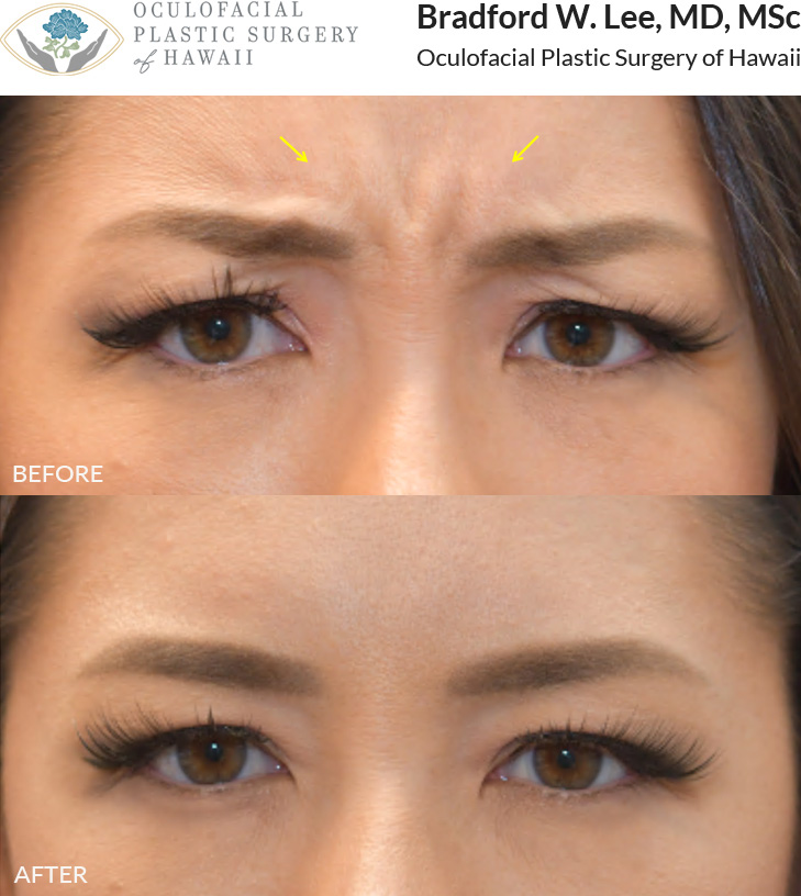 This patient was looking to soften the appearance of her dynamic frown lines or “11 lines.”