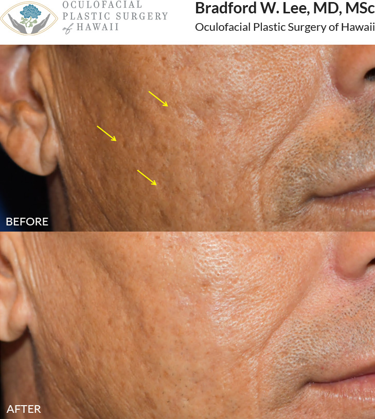 This patient underwent filler treatment to restore volume to acne scars on his cheeks, resulting in a visibly smoother and more even appearance.