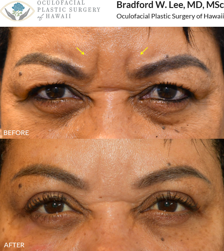 This patient was looking to soften the appearance of her deep static frown lines or “11 lines” while maintaining some natural movement.