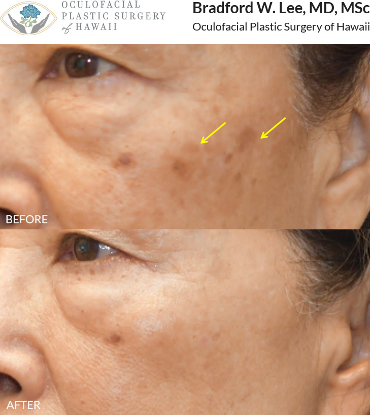 This patient was bothered by the brown spots on her cheeks and underwent 3 sessions of Picosure laser to address this.