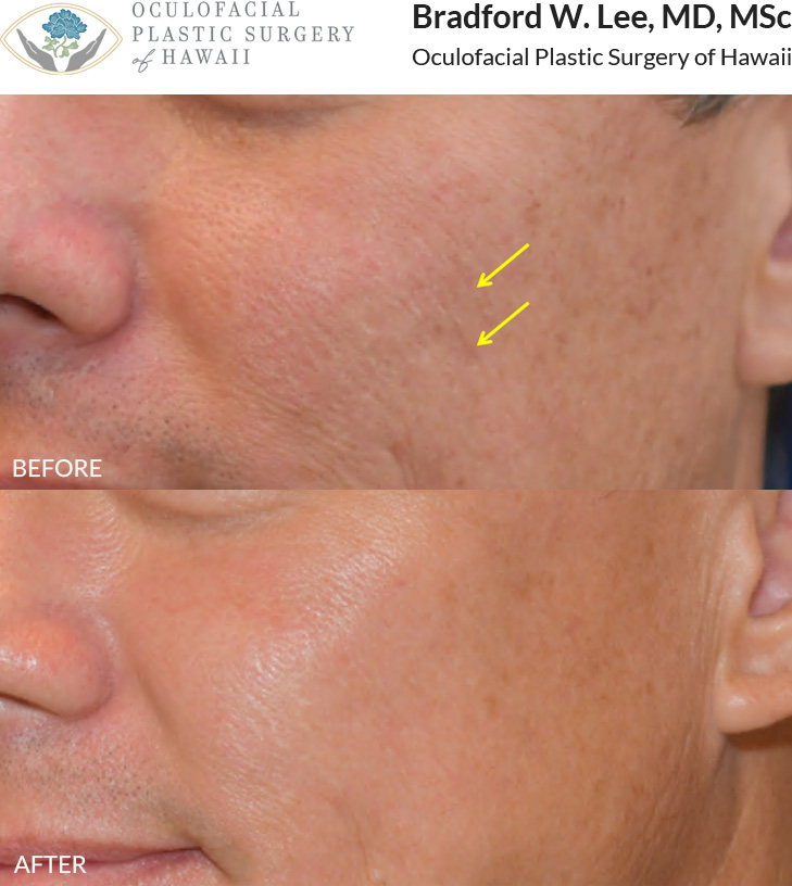 This patient was concerned about his acne scars and underwent 2 sessions of Picosure laser treatment to improve his skin texture. Our Picosure laser is effective not only for removing sunspots but also for refining skin texture.