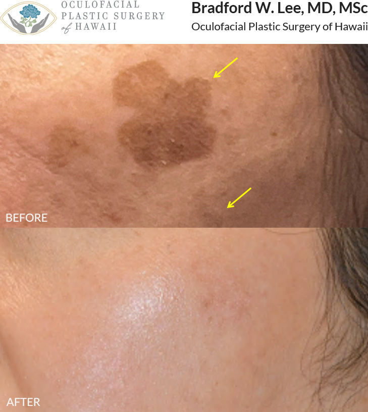 This patient was bothered by the appearance of sunspots on her cheeks and underwent 3 sessions of Picosure laser to address this.