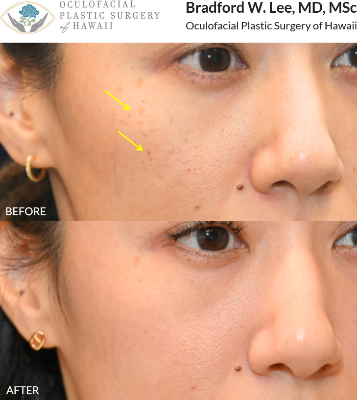 This patient was bothered by the sunspots on her cheeks and underwent 3 sessions of Picosure laser to address this.