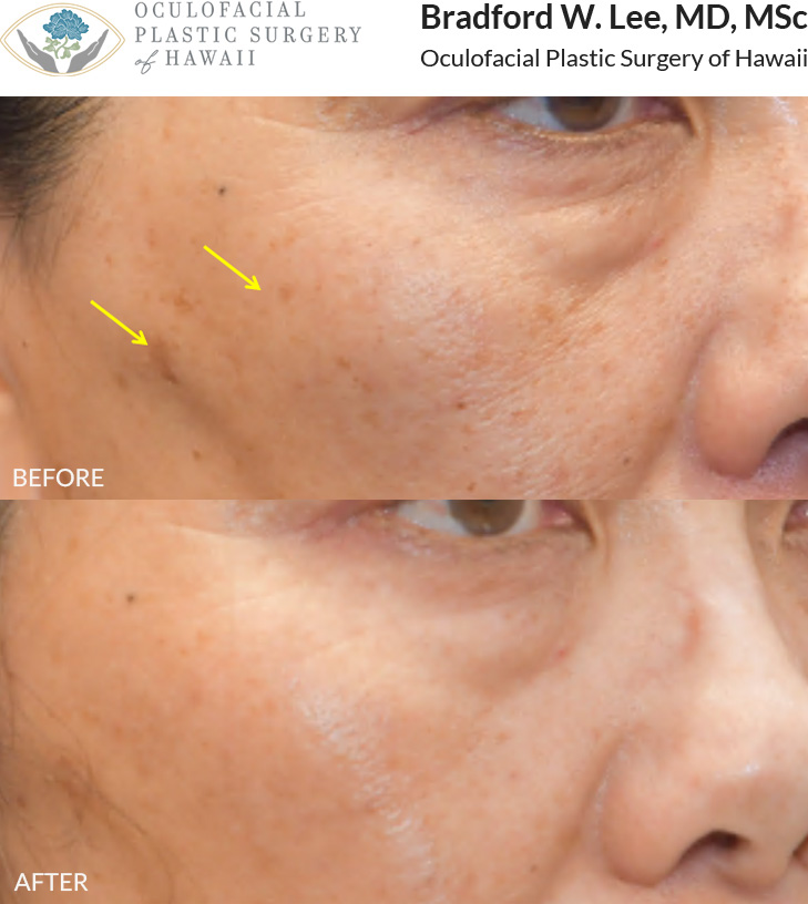 The patient was concerned about brown spots and uneven skin texture on her face. She received 3 sessions of Picosure laser treatment to diminish the dark spots and enhance her overall complexion.