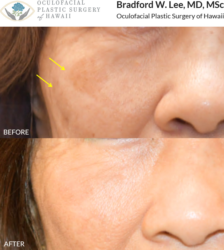 This patient was bothered by the brown spots on her cheeks and underwent 3 sessions of Picosure laser to even out her skin tone.