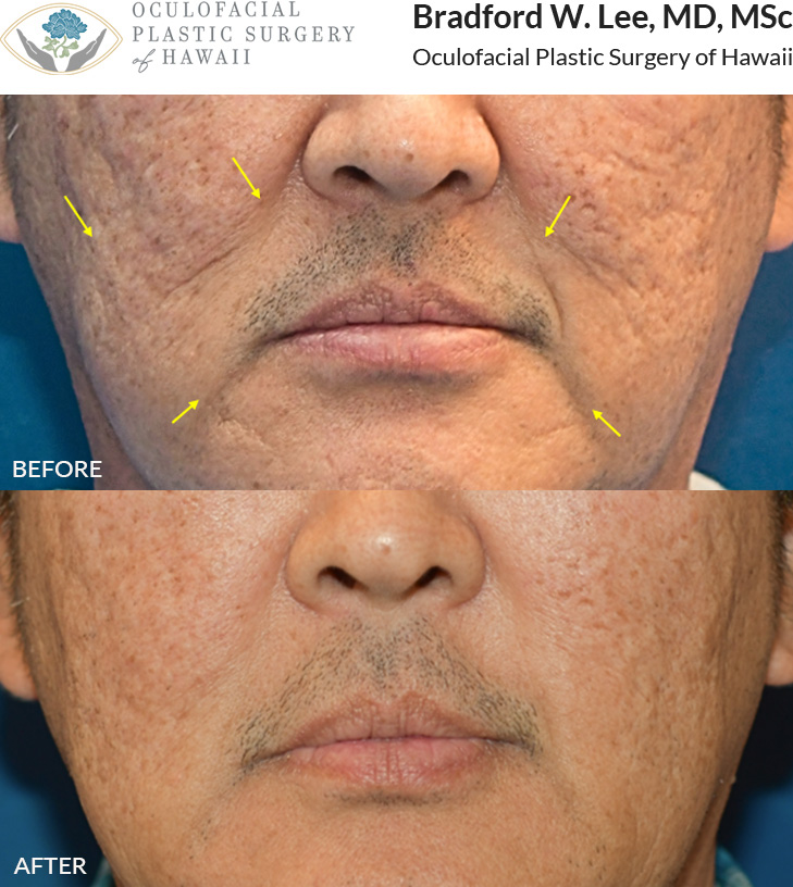 This patient was concerned about facial hollowing in the marionette region and nasolabial folds, as well as depressed acne scars on the cheeks. He underwent a fat transfer procedure to restore volume to these areas, for a more smooth and youthful appearance.