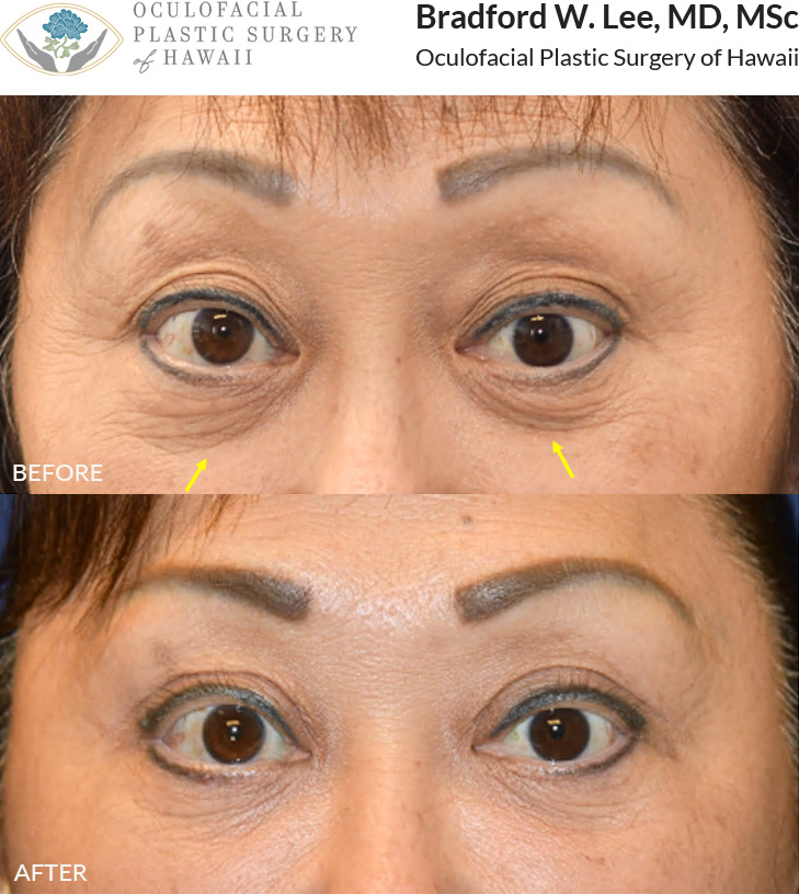 This patient was bothered by the excess skin on her upper eyelids and the hollowing of her lower eyelids. She underwent an upper blepharoplasty to remove that excess skin with fat transfer to the lower eyelids for a smoother under eye appearance.