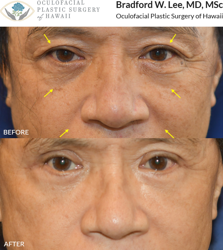 This patient was bothered by the excess skin on his upper and lower eyelids and was looking to fresh his overall appearance. He underwent and upper and lower (quad) blepharoplasty with fat transfer to the tear trough region, cheeks, nasolabial folds, marionette lines, and chin to restore facial volume and rejuvenate his overall appearance.