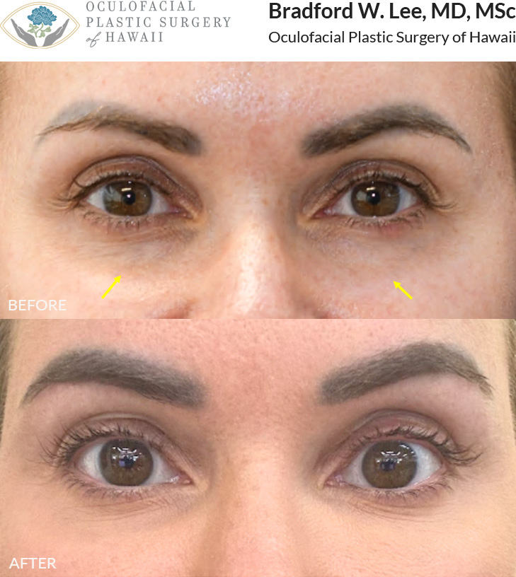 Fat Transfer to Lower Eyelids