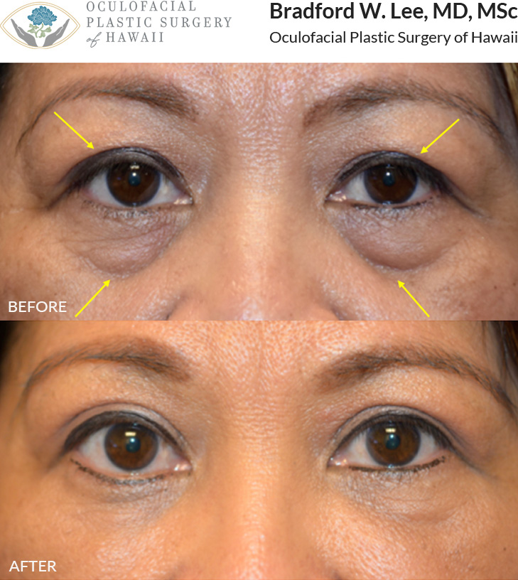 This patient was bothered by excess skin covering her eyelid crease, a smaller aperture of the left eye, and dramatic hollowing along the lower lids into the cheek. She underwent a left ptosis repair, upper blepharoplasty, and liposuction with fat transfer to the lower eyelids to improve the symmetry of the eye apertures, improved definition of the upper lid creases, and a rejuvenated appearance to the lower eyelids.