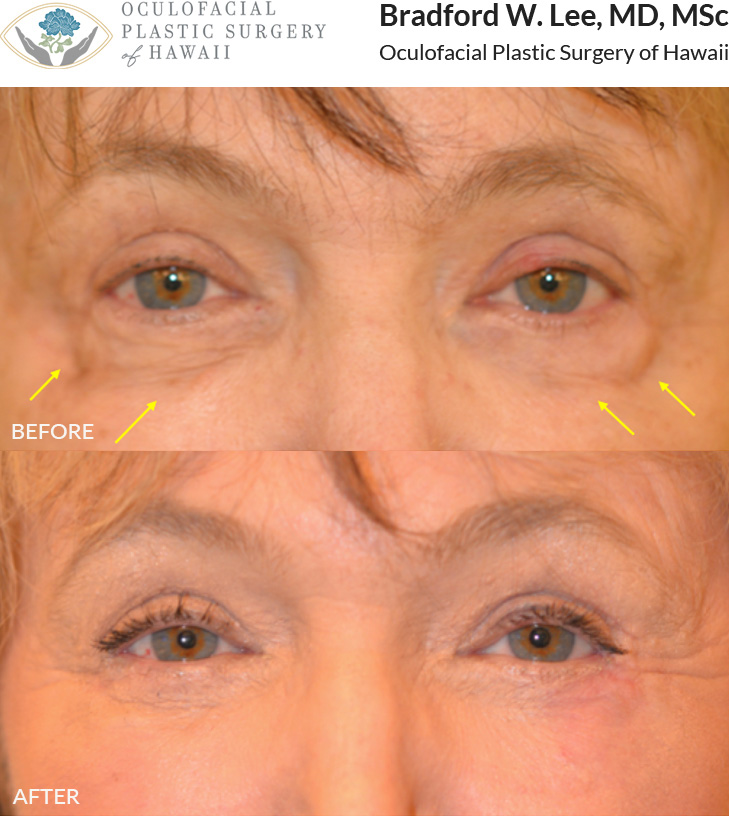 This patient saw a general plastic surgeon who performed fat transfer to the lower lids that resulted in bulging lumps of fat on the lower eyelids without improvement in her lower lid hollowing. She underwent a revision procedure with Dr. Lee, including a lower blepharoplasty with fat repositioning, liposuction with fat transfer to the under eye region, and laser skin resurfacing for a smoother, more youthful contour to the lower eyelids.