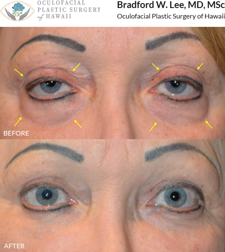 This patient underwent a quad blepharoplasty with a general plastic surgeon but was bothered by the uncorrected eyelid ptosis that made her eyes look sleepy and half closed, residual excess skin on the upper eyelids, and fat prolapse and hollowing under the eyes. She underwent a 4-lid blepharoplasty with fat repositioning, liposuction with fat transfer to the lower lids, and laser resurfacing resulting in a more alert and youthful appearance to the upper and lower eyelids.