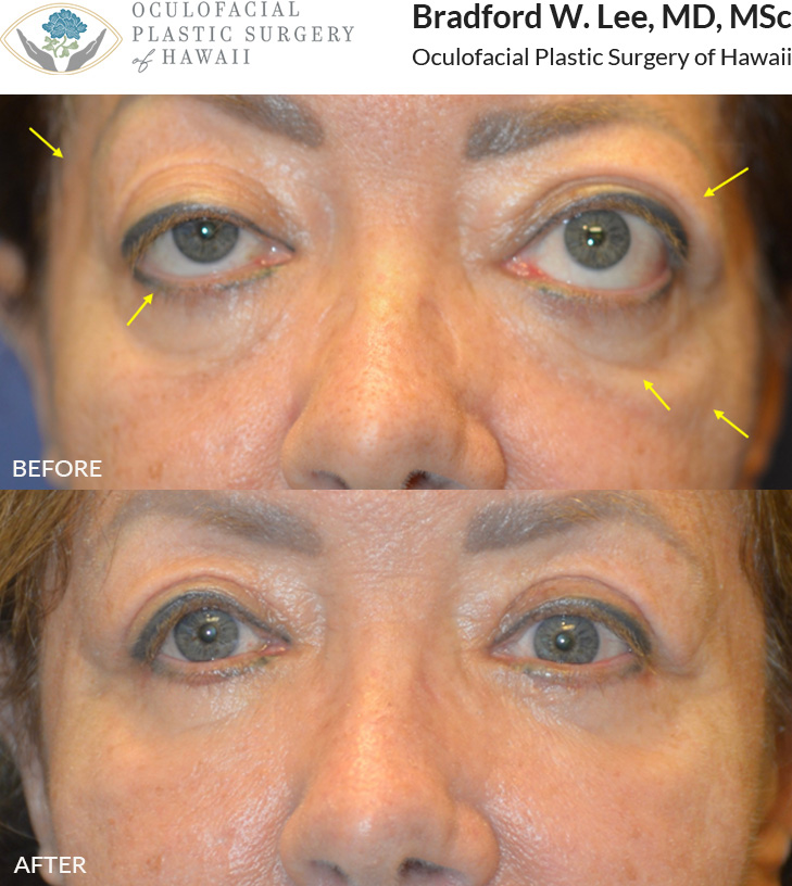 This patient with thyroid eye disease was bothered by the bulging of her eyes, lower eyelid retraction, excess skin on both upper and lower eyelids, and age-related atrophy of the temples, under eye region, and cheeks. She underwent bilateral orbital decompression surgery, eyelid retraction repair, quad blepharoplasty, and fat transfer to the temples, cheeks, and lower lids to reduce the bulging of the eyes, improve the position and symmetry of the eyelids, and restore youthful facial contours in the periocular region.