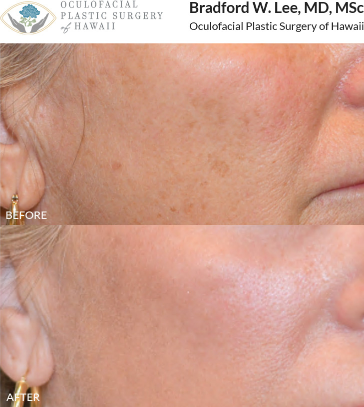 The patient was concerned about photodamage to her skin and underwent a CO2 laser treatment to enhance skin texture and improve overall skin quality.