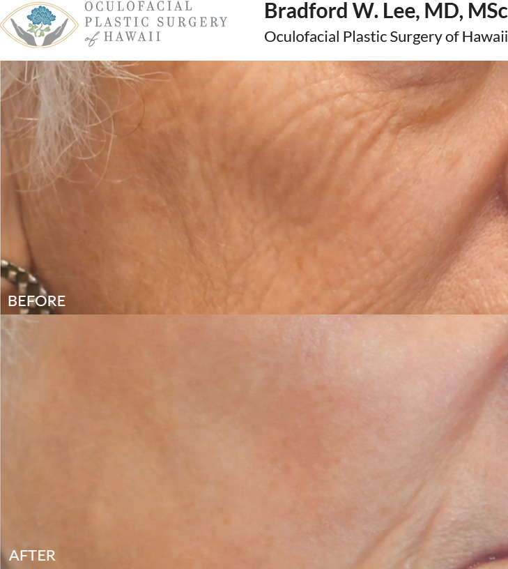 The patient was interested in facial rejuvenation and chose CO2 laser skin resurfacing to reduce fine lines and wrinkles, achieving a softer, more refreshed appearance.