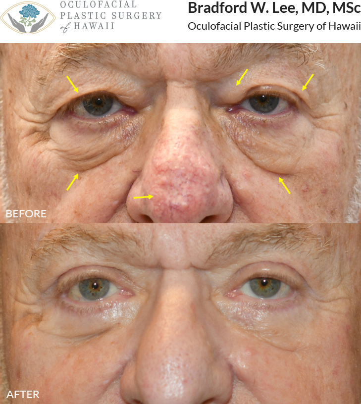 This patient was troubled by excess skin and droopiness of his upper eyelids, which affected his ability to drive and read. He underwent an upper and lower (quad) blepharoplasty with a brow lift to remove the excess skin and fat and lift his brows, improving both his vision and overall appearance. Additionally, he opted for CO2 laser treatment to address his rhinophyma, a skin disorder that causes the nose to enlarge and become red, bumpy, and bulbous. *This photo was taken at 3 months post-op, and the mild residual redness/swelling on the upper lids will continue to resolve over time.*