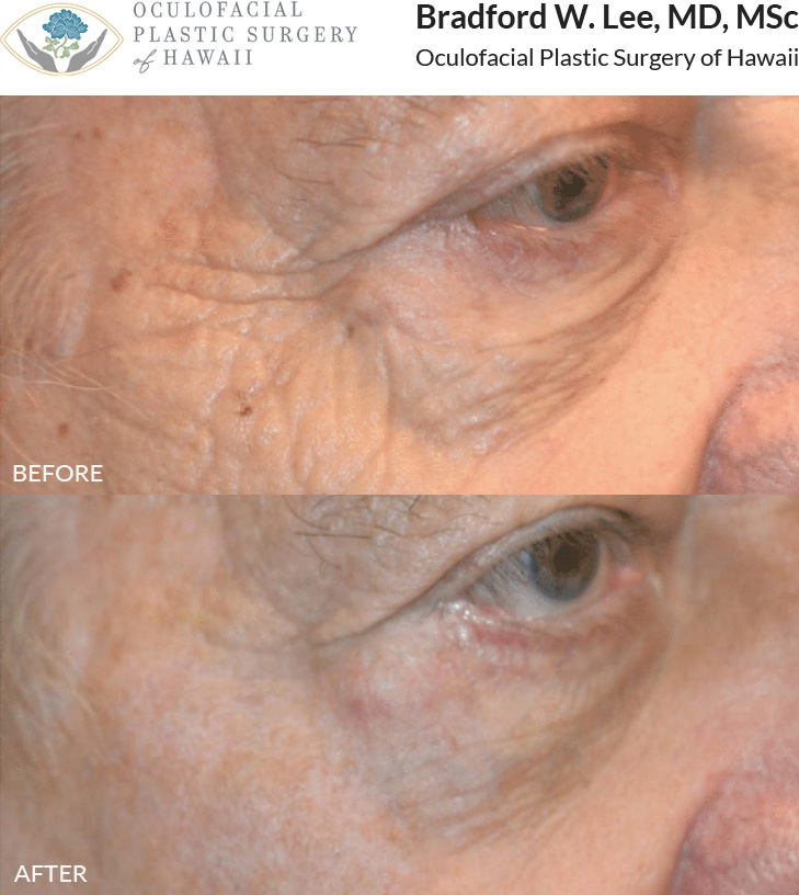 This patient presented with deep wrinkles and textural changes of the cheek. He had 1 session of CO2 laser resurfacing to improve the appearance of wrinkles and smooth the texture of his skin.