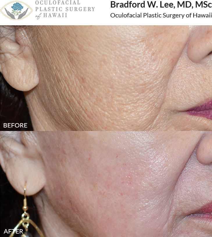 This patient was bothered by the deep wrinkles and textural changes of the skin and wanted dramatic skin rejuvenation. She had two session of CO2 laser resurfacing and achieved smoother, more radiant skin with collagen stimulation and removal of years of sun damage. There may be some residual redness following the treatment, which should resolve over the next few weeks.