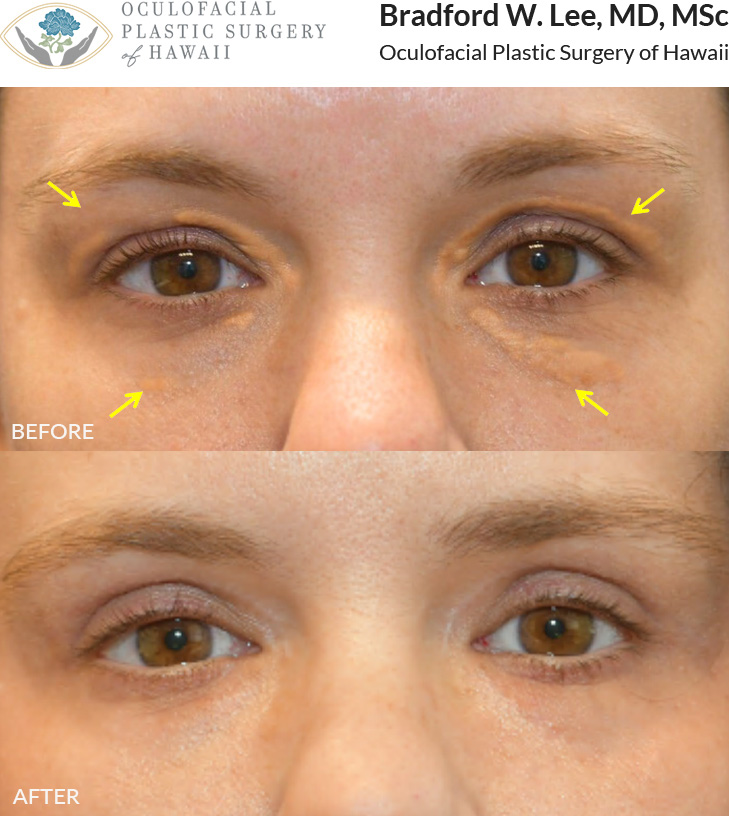 The patient was concerned about the appearance of xanthelasma on her upper and lower eyelids. She underwent a quad blepharoplasty and one session of CO2 laser treatment, which resulted in a smoother and brighter complexion.