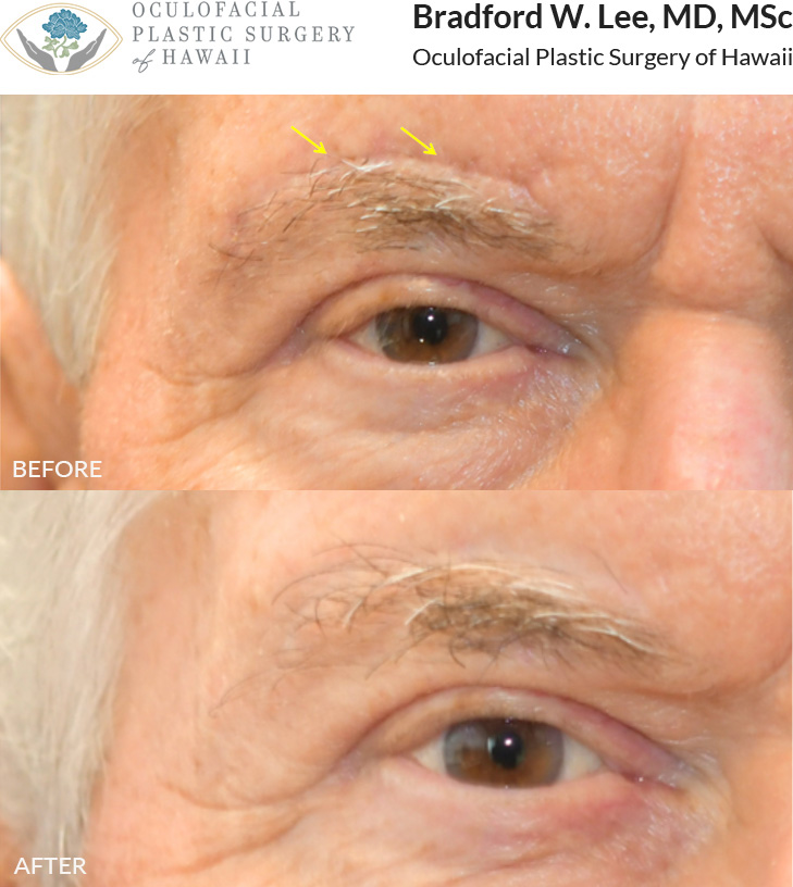 This patient had 2 sessions of CO2 laser scar resurfacing to treat the surgical scar above his brow. Laser scar resurfacing can be repeated multiple times, and each time the results can continue to improve significantly. The best time to treat scars is within the first month following surgery or other cause of scarring (such as traumatic injury).