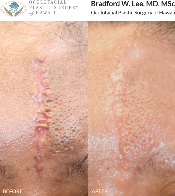 This patient had multiple sessions of CO2 laser scar resurfacing to treat the surgical scar on her forehead following the removal of a growth. Laser scar resurfacing can be repeated multiple times, and each time the results can continue to improve significantly. The best time to treat scars is within the first month following surgery or other cause of scarring (such as traumatic injury).