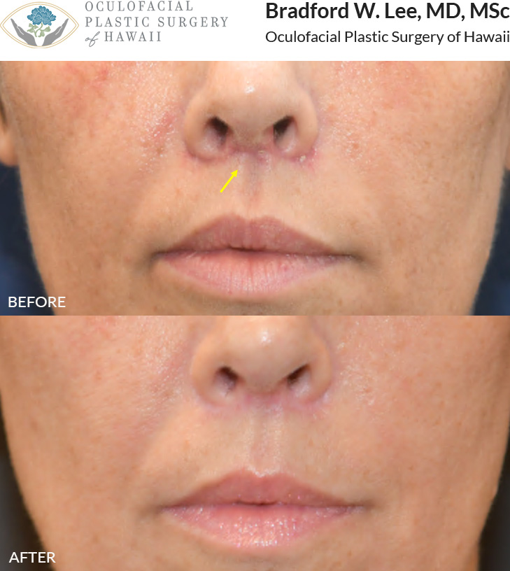 This patient had 3 sessions of CO2 laser scar resurfacing to treat the surgical scar above her lip. Laser scar resurfacing can be repeated multiple times, and each time the results can continue to improve significantly. The best time to treat scars is within the first month following surgery or other cause of scarring (such as traumatic injury).