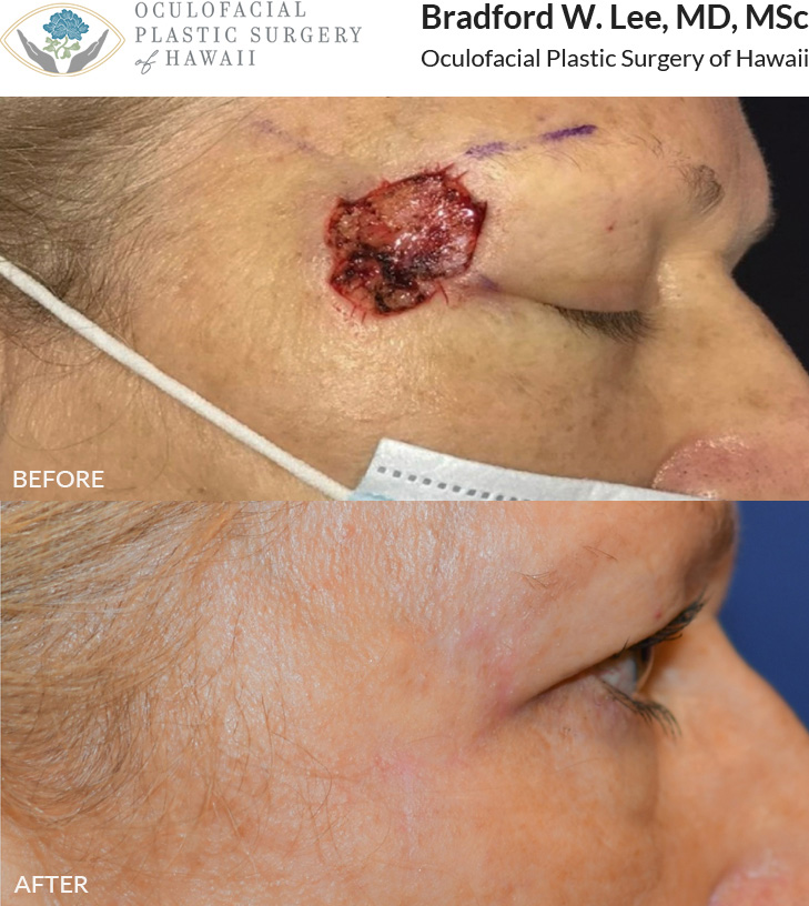 This patient underwent Mohs skin cancer surgery to remove skin cancer, followed by reconstructive surgery and laser scar resurfacing. She healed beautifully and the laser helped to fade the scar and give her the best aesthetic outcome after her reconstructive surgery. Laser scar resurfacing is an amazing option to fade scars that are thickened, uncomfortable, discolored, or aesthetically displeasing.