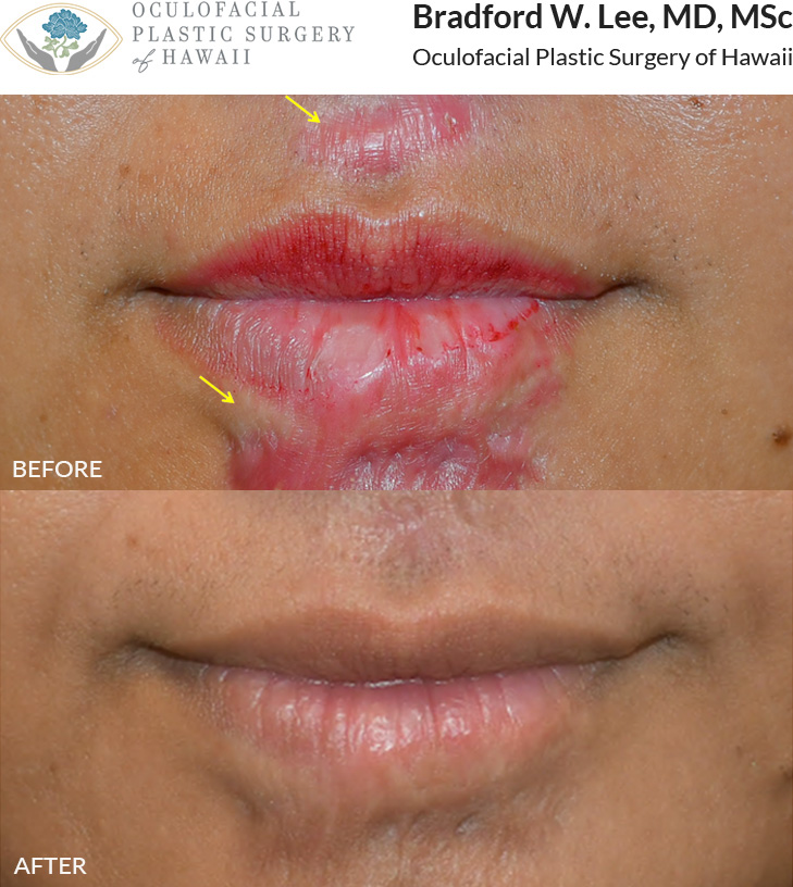 This patient presented with scars around her lips that was causing disfigurement, tightness, and pain. She had 4 sessions of CO2 laser resurfacing with scar injections to help flatten and improve the quality and mobility of the skin. Laser scar resurfacing is most effective early, though results vary, with older scars often needing more sessions and showing less improvement.