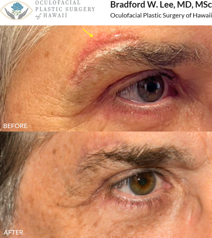 This patient had 2 sessions of CO2 laser scar resurfacing to treat the surgical scar above his brow. Laser scar resurfacing can be repeated multiple times, and each time the results can continue to improve significantly. The best time to treat scars is within the first month following surgery or other cause of scarring (such as traumatic injury).