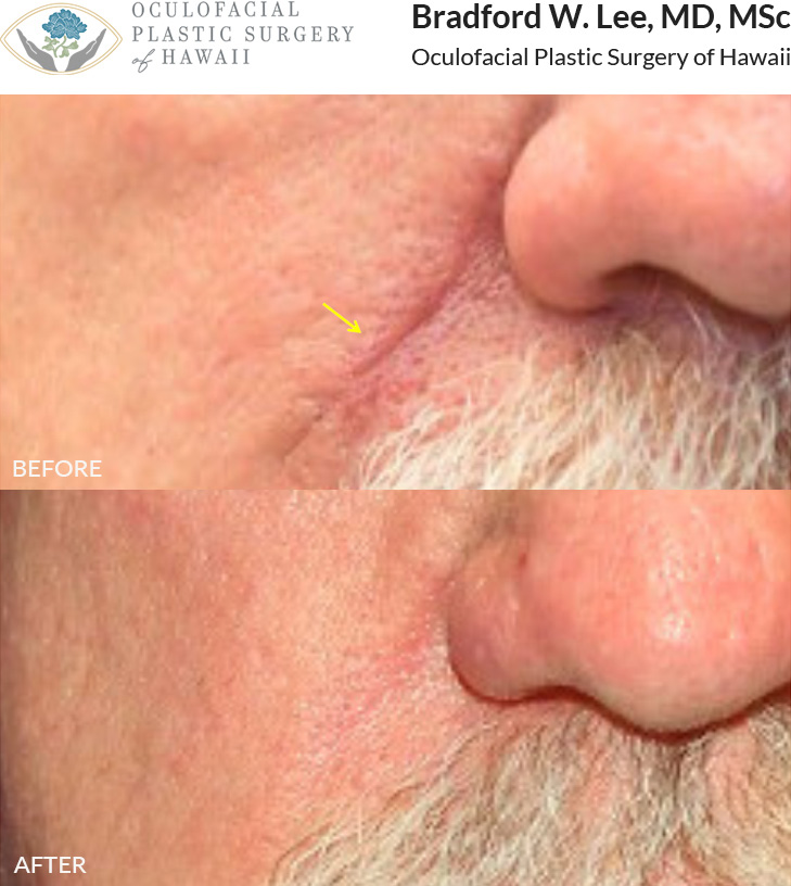 This patient had 2 sessions of CO2 laser scar resurfacing to treat the surgical scar on his nasolabial fold following Mohs skin cancer surgery . Laser scar resurfacing is most effective early, though results vary, with older scars often needing more sessions and showing less improvement.