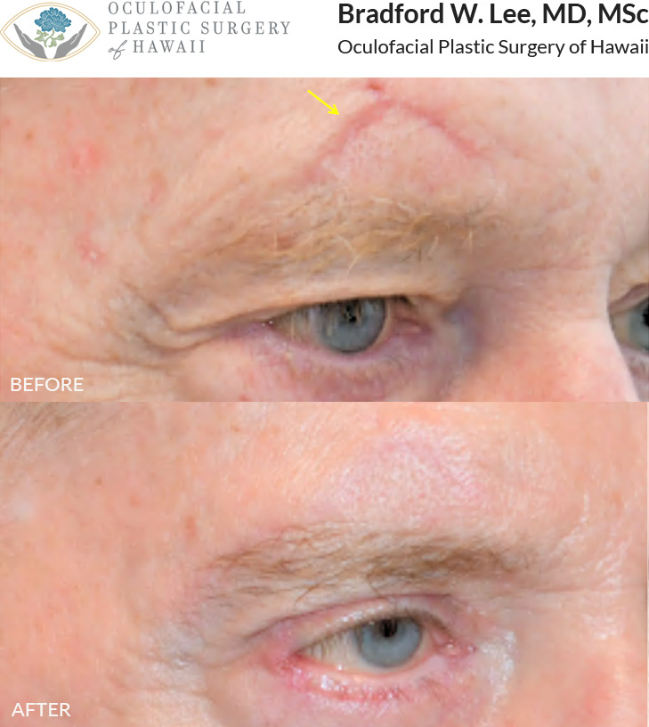 This patient had 2 sessions of CO2 laser scar resurfacing to treat the scar above his brow following an injury. Laser scar resurfacing is most effective early, though results vary, with older scars often needing more sessions and showing less improvement.