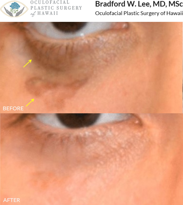 This presented with a scar on the right lower lid that was causing disfigurement and right lower eyelid retraction. He had 2 sessions of CO2 laser resurfacing to help fade the scar, address the lower lid retraction, and improve the quality and texture of the skin.